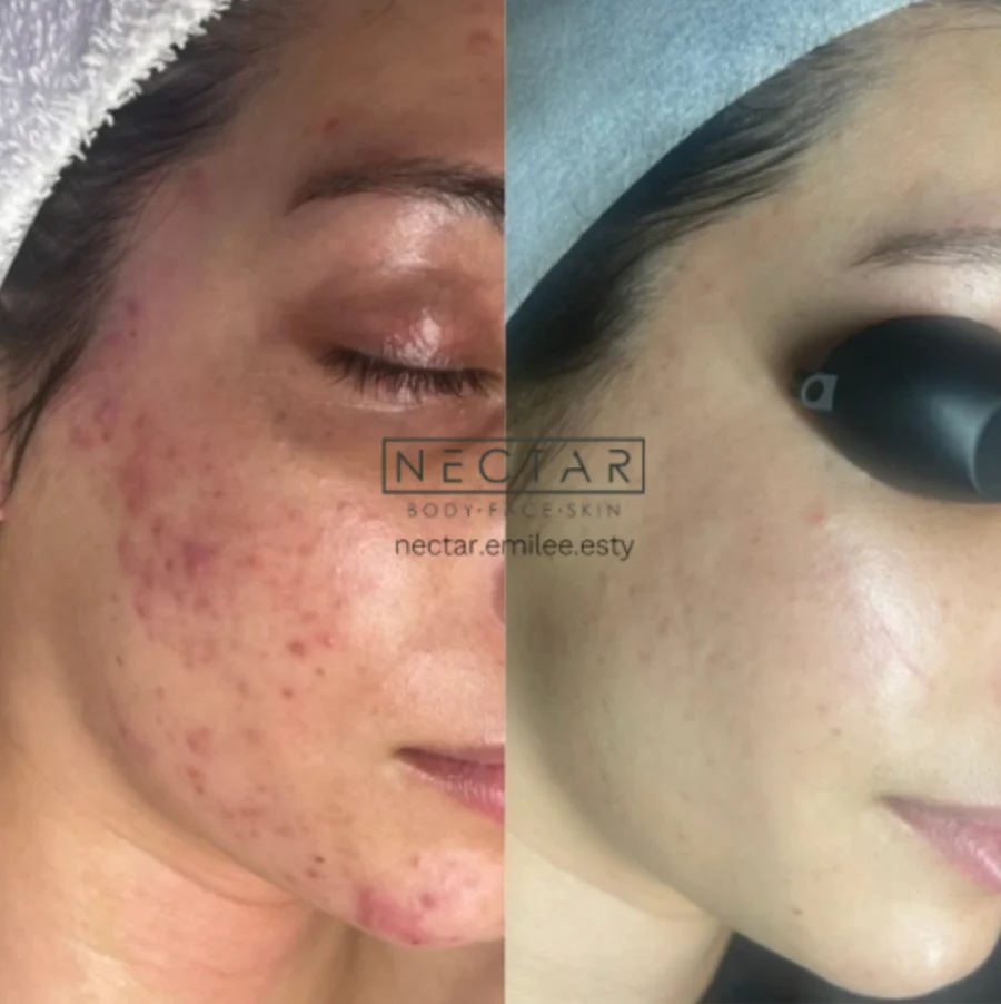 Adult acne before and after results, NECTAR body face skin, treated by Emilee Walters