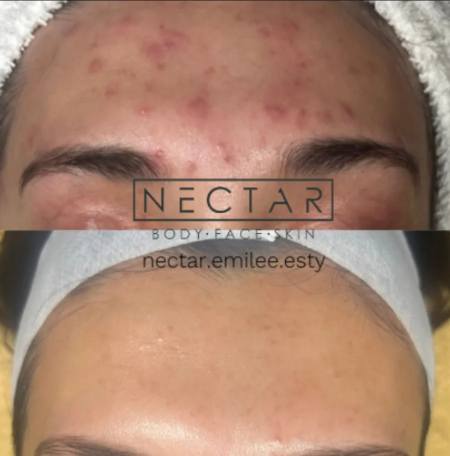 Hormonal acne and forehead clearing progress, NECTAR body face skin treatment plan