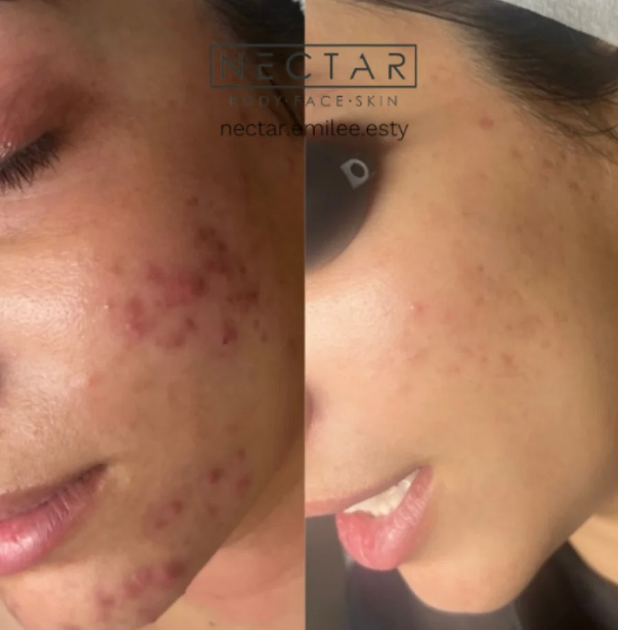 Jawline and cheek acne improvement, NECTAR body face skin acne protocol
