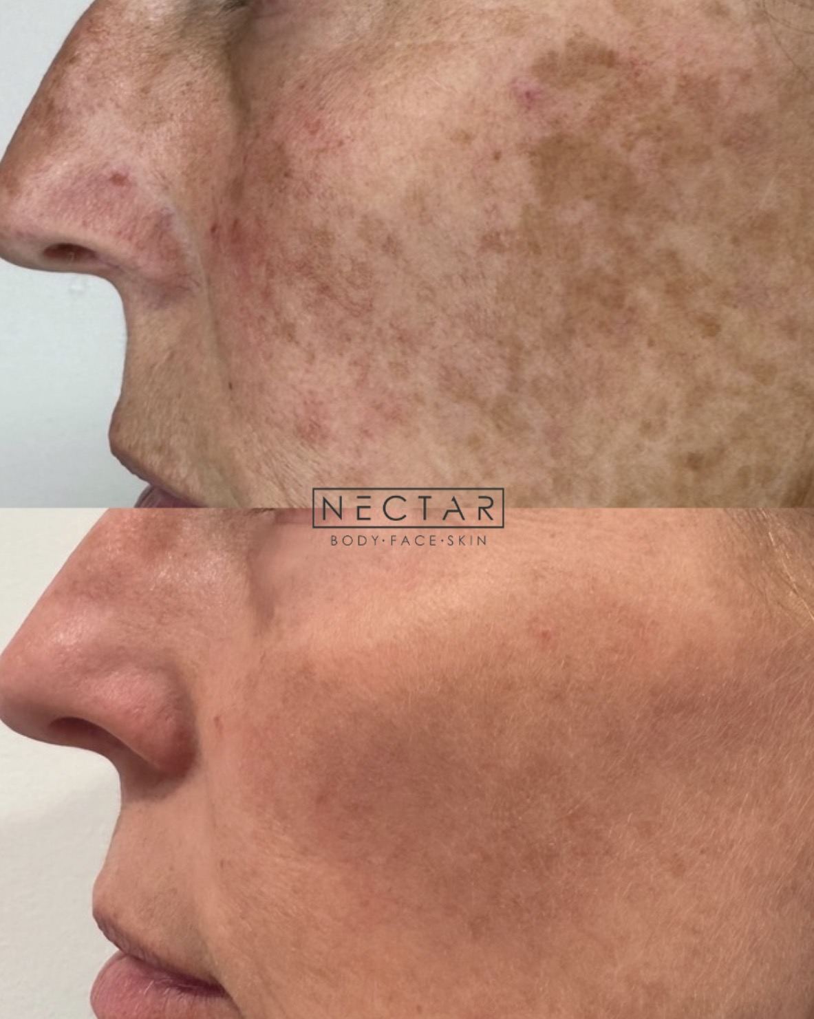 BBL HEROic before and after — sun damage and pigmentation treatment at NECTAR body face skin DeWitt MI