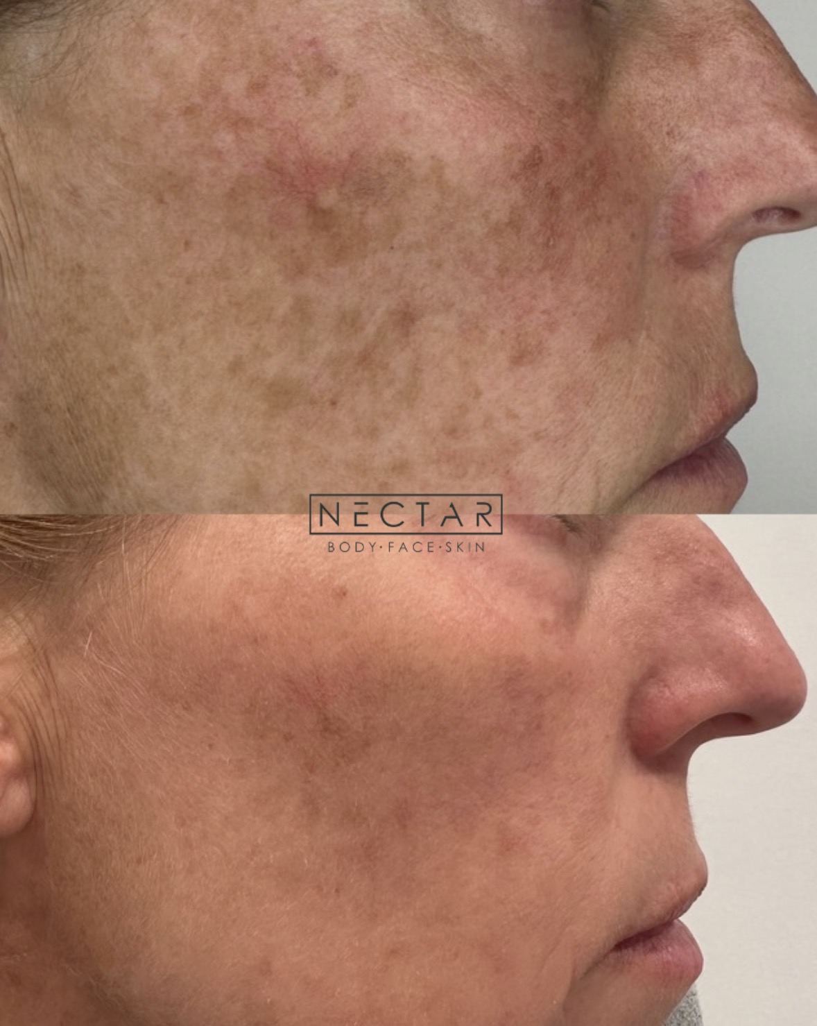 BBL HEROic before and after — uneven skin tone and redness treatment at NECTAR body face skin DeWitt MI