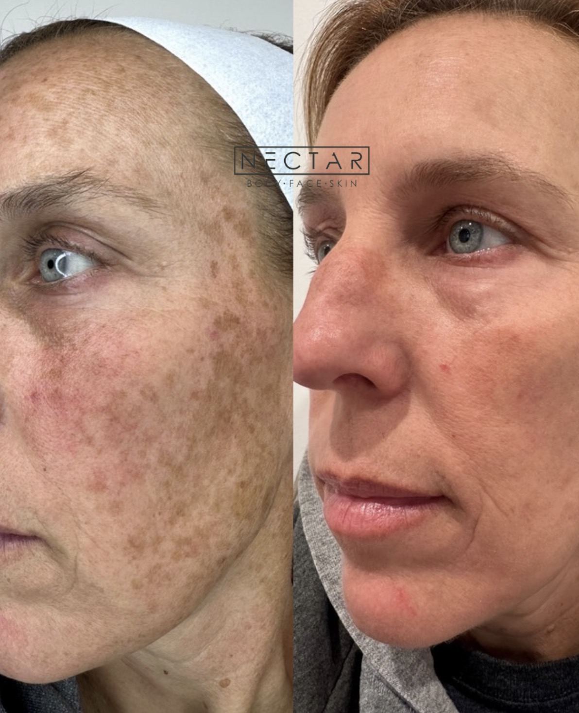 BBL HEROic before and after — brown spots and sun damage results at NECTAR body face skin DeWitt MI
