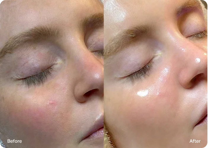 Hydrafacial before and after, undereye hydration and skin glow results at NECTAR body face skin DeWitt MI