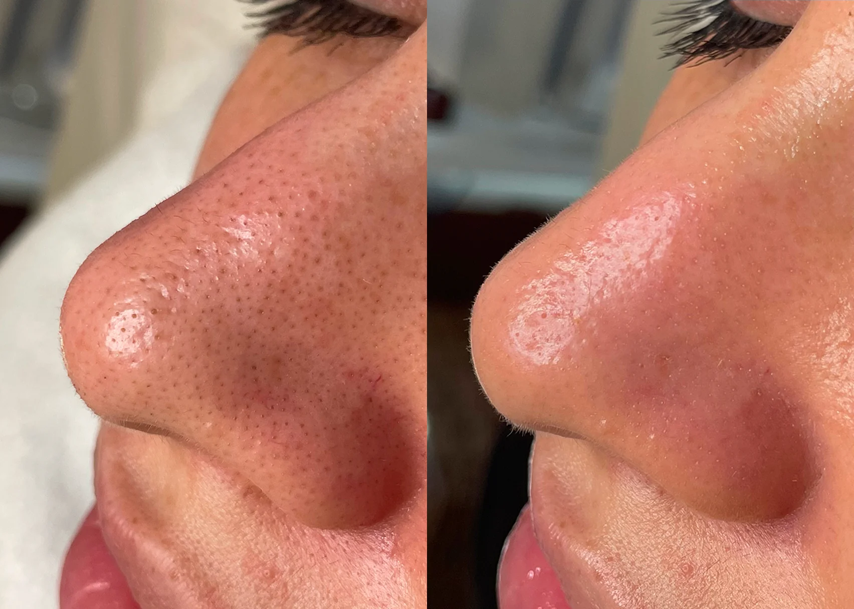 Hydrafacial before and after, blackhead and clogged pore extraction results on nose at NECTAR body face skin DeWitt MI